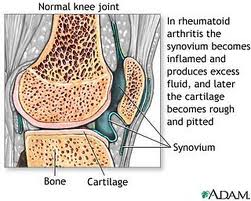 Obat Lutut Sakit dan Bengkak
